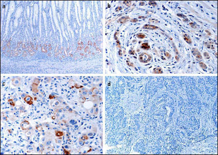 Immunohistochemical of EphB1 in gastric cancer tissues. a EphB1 protein expressed in normal mucosa at the glandular compartment and in a decreasing gradient from the glandular compartment to the foveolar compartment. b EphB1 protein focally positively stained in well-differentiated gastric cancer cells. c EphB1 protein is focally positive in poorly differentiated gastric cancer cells. d Loss of EphB1 expression in gastric cancer cells.(Provided by Jian-dong Wang,Department of Pathology Nanjing Jinling Hospital/Nanjing University School of Medicine)