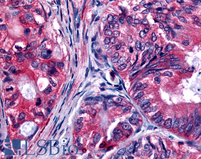 Anti-EPHB2 / EPH Receptor B2 antibody IHC of human Colon, Carcinoma. Immunohistochemistry of formalin-fixed, paraffin-embedded tissue after heat-induced antigen retrieval.