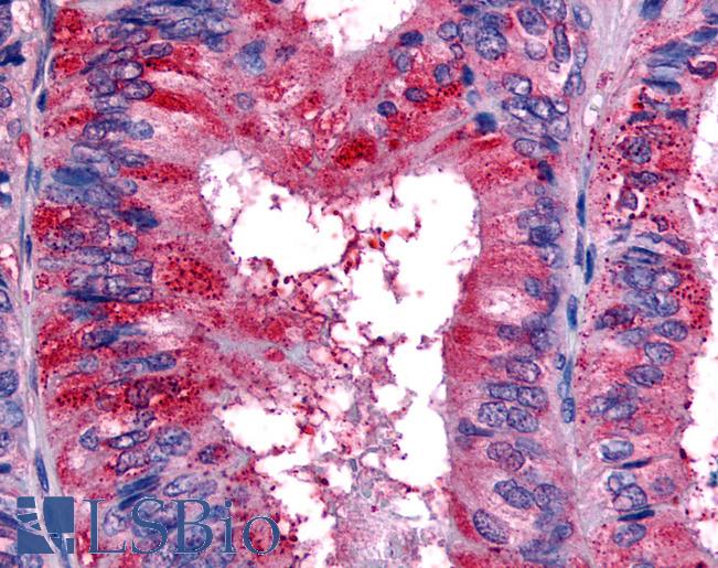 Anti-EPHB2 / EPH Receptor B2 antibody IHC of human Colon, Carcinoma. Immunohistochemistry of formalin-fixed, paraffin-embedded tissue after heat-induced antigen retrieval.
