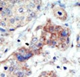 Formalin-fixed and paraffin-embedded human cancer tissue reacted with the primary antibody, which was peroxidase-conjugated to the secondary antibody, followed by DAB staining. This data demonstrates the use of this antibody for immunohistochemistry; clinical relevance has not been evaluated. BC = breast carcinoma; HC = hepatocarcinoma.