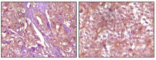 IHC of paraffin-embedded Human pancreas carcinoma (left) and breast carcinoma (right) tissue, showing membrane and cytoplasmic (pancreas carcinoma) localization, membrane (breast carcinoma) localization using EphB4 mouse