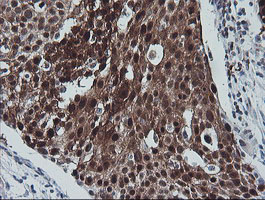 IHC of paraffin-embedded Carcinoma of Human bladder tissue using anti-CMPK1 mouse monoclonal antibody.