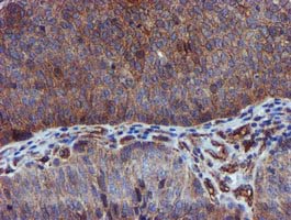 IHC of paraffin-embedded Carcinoma of Human bladder tissue using anti-EPN2 mouse monoclonal antibody.