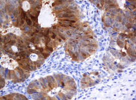 IHC of paraffin-embedded Adenocarcinoma of Human colon tissue using anti-CMPK1 mouse monoclonal antibody.