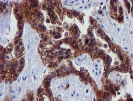 IHC of paraffin-embedded Carcinoma of Human lung tissue using anti-EPN2 mouse monoclonal antibody. (Heat-induced epitope retrieval by 10mM citric buffer, pH6.0, 100C for 10min).