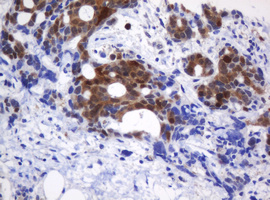 IHC of paraffin-embedded Adenocarcinoma of Human breast tissue using anti-CMPK1 mouse monoclonal antibody.