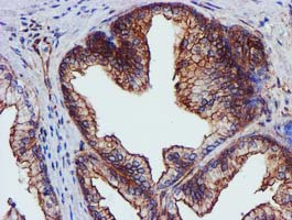 IHC of paraffin-embedded Carcinoma of Human prostate tissue using anti-EPN2 mouse monoclonal antibody. (Heat-induced epitope retrieval by 10mM citric buffer, pH6.0, 100C for 10min).