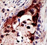 Formalin-fixed and paraffin-embedded human cancer tissue reacted with the primary antibody, which was peroxidase-conjugated to the secondary antibody, followed by AEC staining. This data demonstrates the use of this antibody for immunohistochemistry; clinical relevance has not been evaluated. BC = breast carcinoma; HC = hepatocarcinoma.