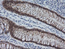 IHC of paraffin-embedded Adenocarcinoma of Human colon tissue using anti-CMPK1 mouse monoclonal antibody. (Heat-induced epitope retrieval by 10mM citric buffer, pH6.0, 100C for 10min).