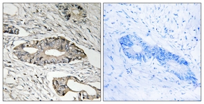 IHC of paraffin-embedded human colon carcinoma tissue, using EPN3 Antibody. The picture on the right is treated with the synthesized peptide.