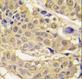 Formalin-fixed and paraffin-embedded human breast carcinoma tissue reacted with EPRS antibody , which was peroxidase-conjugated to the secondary antibody, followed by DAB staining. This data demonstrates the use of this antibody for immunohistochemistry; clinical relevance has not been evaluated.