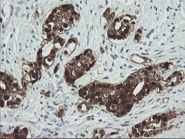 IHC of paraffin-embedded Carcinoma of Human prostate tissue using anti-CMPK1 mouse monoclonal antibody.