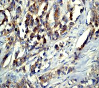 IHC of paraffin-embedded human breast carcinoma using anti-EPS15R antibody.