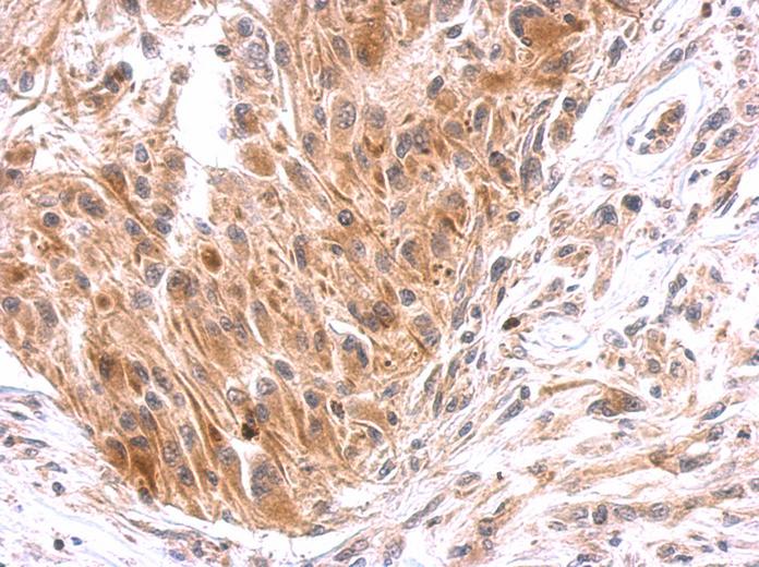 EPS8 antibody [C3], C-term detects EPS8 protein at cytosol on U373 xenograft by immunohistochemical analysis. Sample: Paraffin-embedded U373 xenograft. EPS8 antibody [C3], C-term dilution:1:500.