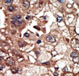 Formalin-fixed and paraffin-embedded human cancer tissue reacted with the primary antibody, which was peroxidase-conjugated to the secondary antibody, followed by DAB staining. This data demonstrates the use of this antibody for immunohistochemistry; clinical relevance has not been evaluated. BC = breast carcinoma; HC = hepatocarcinoma.