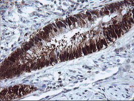 IHC of paraffin-embedded Adenocarcinoma of Human colon tissue using anti-CMPK1 mouse monoclonal antibody.
