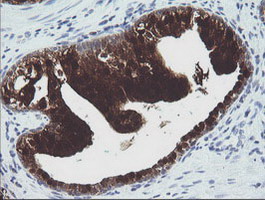 IHC of paraffin-embedded Carcinoma of Human prostate tissue using anti-CMPK1 mouse monoclonal antibody.