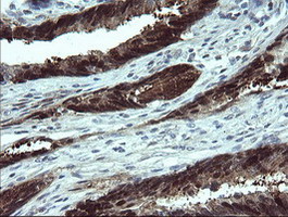 IHC of paraffin-embedded Adenocarcinoma of Human colon tissue using anti-CMPK1 mouse monoclonal antibody.