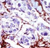 Formalin-fixed and paraffin-embedded human cancer tissue reacted with the primary antibody, which was peroxidase-conjugated to the secondary antibody, followed by AEC staining. This data demonstrates the use of this antibody for immunohistochemistry; clinical relevance has not been evaluated. BC = breast carcinoma; HC = hepatocarcinoma.