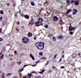 Formalin-fixed and paraffin-embedded human cancer tissue reacted with the primary antibody, which was peroxidase-conjugated to the secondary antibody, followed by AEC staining. This data demonstrates the use of this antibody for immunohistochemistry; clinical relevance has not been evaluated. BC = breast carcinoma; HC = hepatocarcinoma.