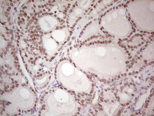 IHC of paraffin-embedded Carcinoma of Human thyroid tissue using anti-MAD2L1BP mouse monoclonal antibody. (Heat-induced epitope retrieval by 1 mM EDTA in 10mM Tris, pH8.5, 120°C for 3min).
