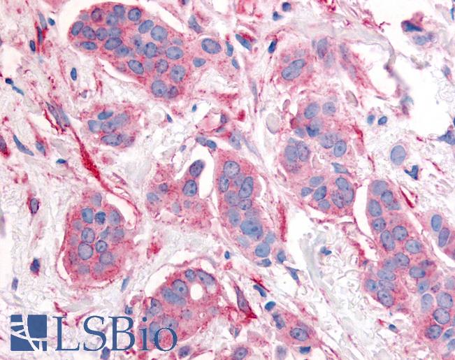 Anti-ERBB2 / HER2 antibody LS-A9398 IHC of human breast carcinoma, neoplastic cells. Immunohistochemistry of formalin-fixed, paraffin-embedded tissue after heat-induced antigen retrieval.