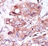 Formalin-fixed and paraffin-embedded human cancer tissue reacted with the primary antibody, which was peroxidase-conjugated to the secondary antibody, followed by DAB staining. This data demonstrates the use of this antibody for immunohistochemistry; clinical relevance has not been evaluated. BC = breast carcinoma; HC = hepatocarcinoma.