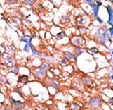Formalin-fixed and paraffin-embedded human cancer tissue reacted with the primary antibody, which was peroxidase-conjugated to the secondary antibody, followed by AEC staining. This data demonstrates the use of this antibody for immunohistochemistry; clinical relevance has not been evaluated. BC = breast carcinoma; HC = hepatocarcinoma.