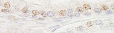 Detection of Human ERCC3 by Immunohistochemistry. Sample: FFPE section of human breast carcinoma. Antibody: Affinity purified rabbit anti-ERCC3 used at a dilution of 1:1000 (1 Detection: DAB.
