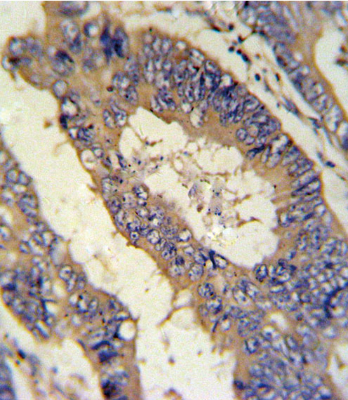 EREG Antibody IHC of formalin-fixed and paraffin-embedded colon carcinoma followed by peroxidase-conjugated secondary antibody and DAB staining.