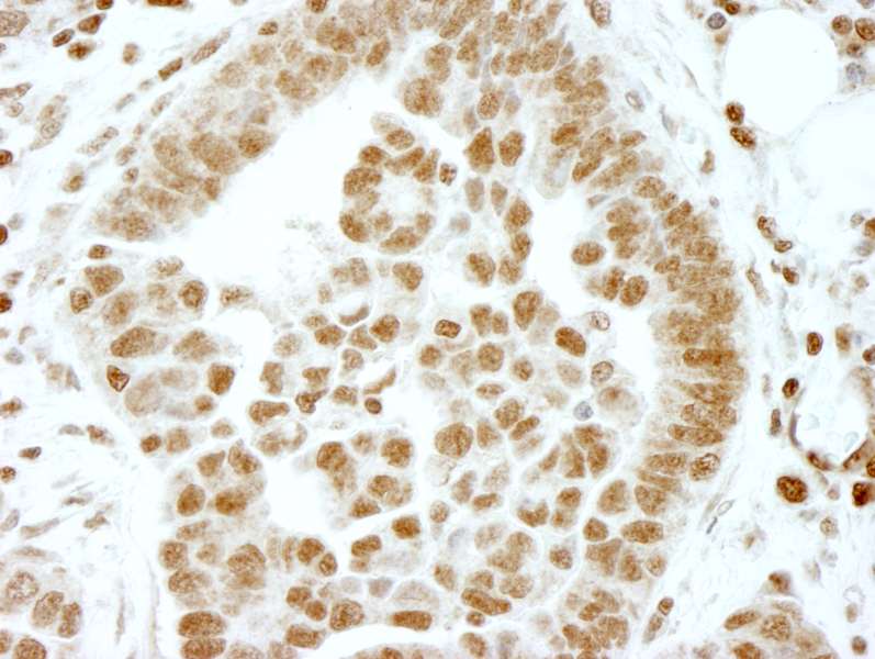Detection of Human ERF by Immunohistochemistry. Sample: FFPE section of human ovarian tumor. Antibody: Affinity purified rabbit anti-ERF used at a dilution of 1:100.