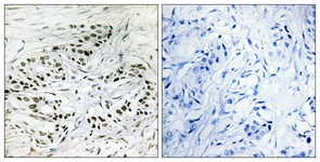 IHC of paraffin-embedded human breast carcinoma tissue, using ERF Antibody. The picture on the right is treated with the synthesized peptide.