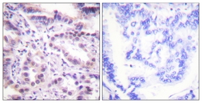 IHC of paraffin-embedded human lung carcinoma, using ERF (Phospho-Thr526) Antibody. The sample on the right was incubated with synthetic peptide.