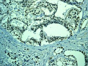 IHC of paraffin-embedded human prostatic adenocarcinoma tissue using anti-ERG antibody.