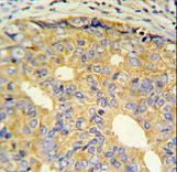 ZNF9 Antibody IHC of formalin-fixed and paraffin-embedded prostate carcinoma followed by peroxidase-conjugated secondary antibody and DAB staining.