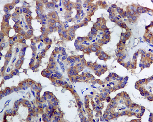 IHC of paraffin-embedded papillary adenocarcinoma tissue using anti-LMAN1 antibody.