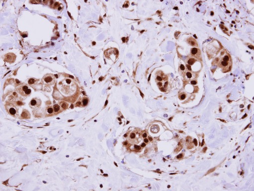 ERH antibody detects ERH protein at cytosol on Breast Carcinoma by immunohistochemical analysis. Sample: Paraffin-embedded Breast Carcinoma. ERH antibody dilution:1:500.