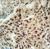 PRNIP Antibody immunohistochemistry of formalin-fixed and paraffin-embedded human lung carcinoma followed by peroxidase-conjugated secondary antibody and DAB staining.