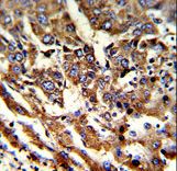 Formalin-fixed and paraffin-embedded human hepatocarcinoma reacted with ERP29 Antibody , which was peroxidase-conjugated to the secondary antibody, followed by DAB staining. This data demonstrates the use of this antibody for immunohistochemistry; clinical relevance has not been evaluated.