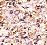 Formalin-fixed and paraffin-embedded human cancer tissue reacted with the primary antibody, which was peroxidase-conjugated to the secondary antibody, followed by DAB staining. This data demonstrates the use of this antibody for immunohistochemistry; clinical relevance has not been evaluated. BC = breast carcinoma; HC = hepatocarcinoma.
