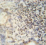 ESRP1 antibody immunohistochemistry of formalin-fixed and paraffin-embedded human colon carcinoma followed by peroxidase-conjugated secondary antibody and DAB staining.
