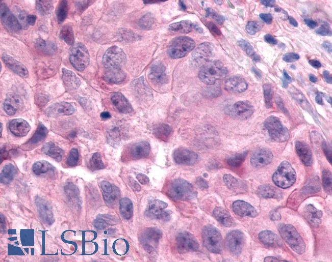 Anti-ESRRA / ERR Alpha antibody IHC of human Lung, Non-Small Cell Carcinoma. Immunohistochemistry of formalin-fixed, paraffin-embedded tissue after heat-induced antigen retrieval.