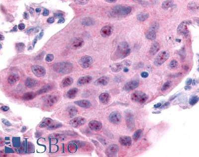 Anti-ESRRA antibody LS-A5402 IHC of human breast carcinoma. Immunohistochemistry of formalin-fixed, paraffin-embedded tissue after heat-induced antigen retrieval.