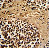 Formalin-fixed and paraffin-embedded human kidney carcinoma reacted with ESRRA Antibody , which was peroxidase-conjugated to the secondary antibody, followed by DAB staining. This data demonstrates the use of this antibody for immunohistochemistry; clinical relevance has not been evaluated.