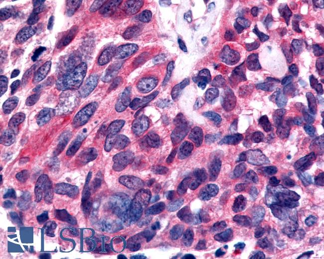 Anti-ESRRB / ERR Beta antibody IHC of human Lung, Small Cell Carcinoma. Immunohistochemistry of formalin-fixed, paraffin-embedded tissue after heat-induced antigen retrieval.