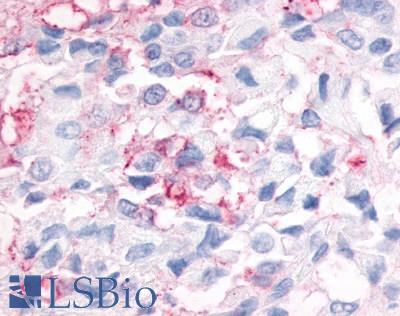 Anti-ESRRG / ERR3 antibody LS-A2400 IHC of human breast cancer. Immunohistochemistry of formalin-fixed, paraffin-embedded tissue after heat-induced antigen retrieval.