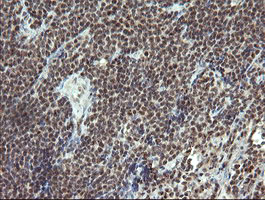 IHC of paraffin-embedded Human lymphoma tissue using anti-ESRRG mouse monoclonal antibody.