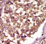Formalin-fixed and paraffin-embedded human cancer tissue reacted with the primary antibody, which was peroxidase-conjugated to the secondary antibody, followed by AEC staining. This data demonstrates the use of this antibody for immunohistochemistry; clinical relevance has not been evaluated. BC = breast carcinoma; HC = hepatocarcinoma.