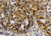 IHC of ETS1 (A32) pAb in paraffin-embedded human hepatic carcinoma tissue.