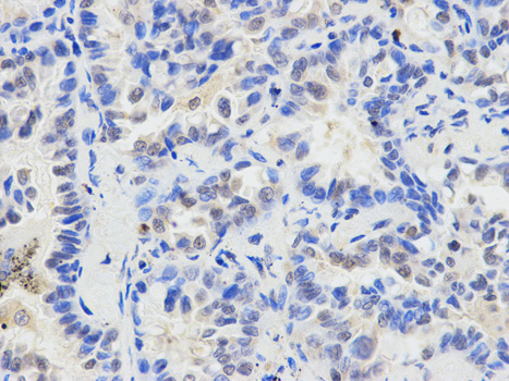 Immunohistochemistry of paraffin-embedded human lung cancer using ETV6 antibody at dilution of 1:200 (400x lens).